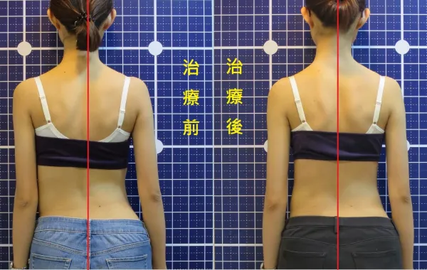 脊聲動 | 脊椎側彎 / 脊柱側彎  矯正成功分享