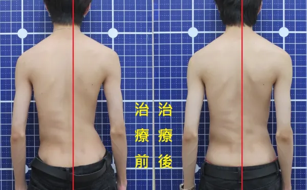 脊聲動 | 脊椎側彎 / 脊柱側彎  矯正成功分享