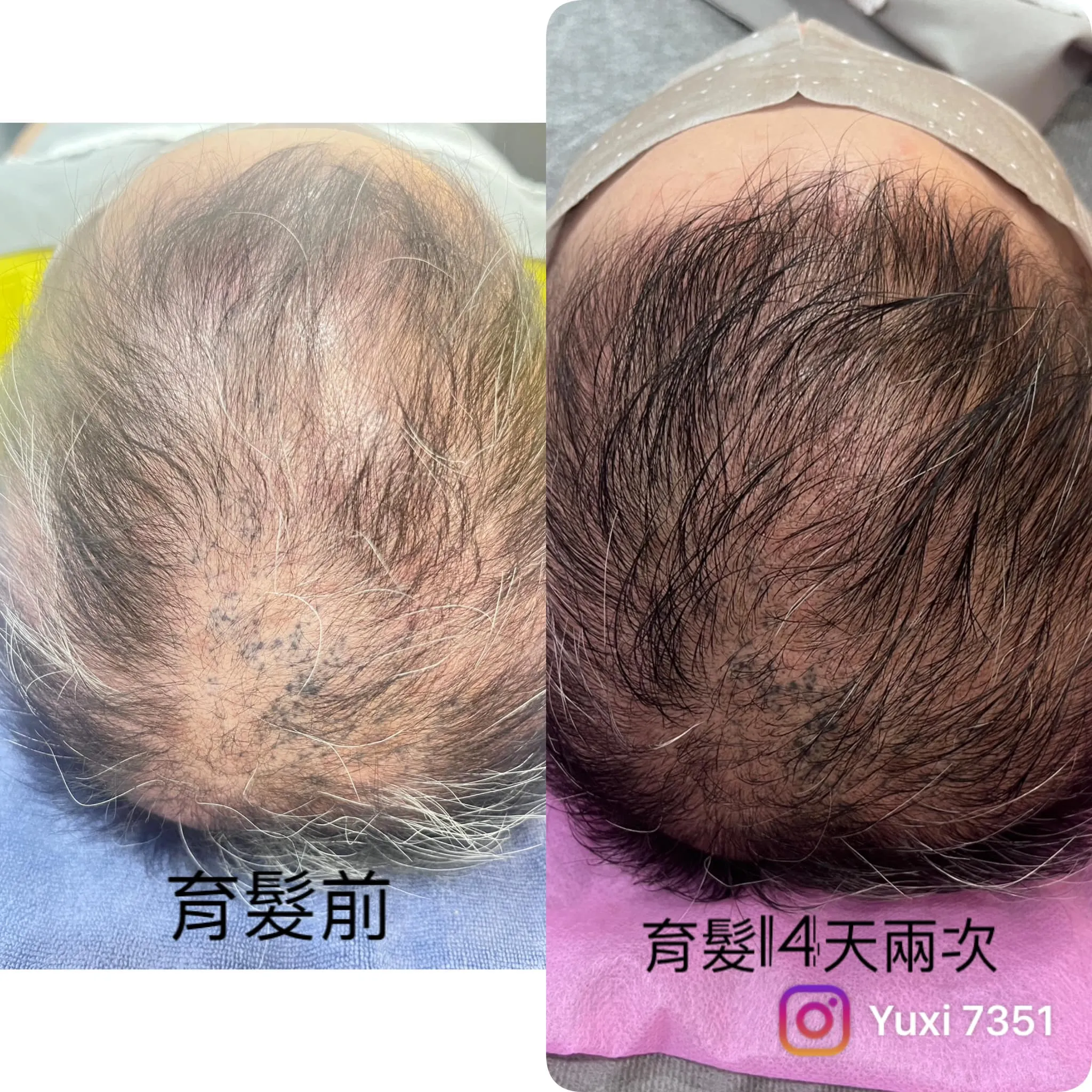 #兩年前這位顧客因為打疫苗導致頭髮掉光