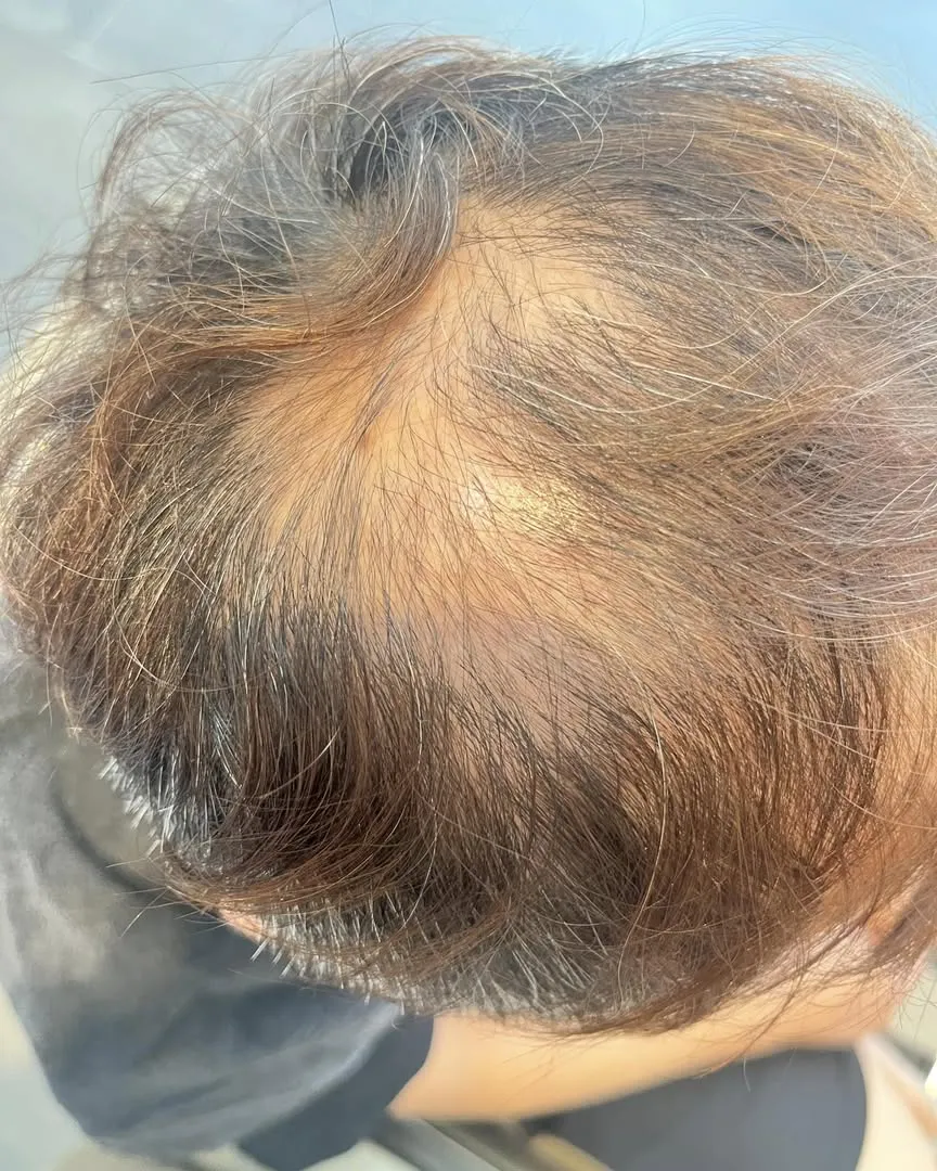 造成落髮問題6大類