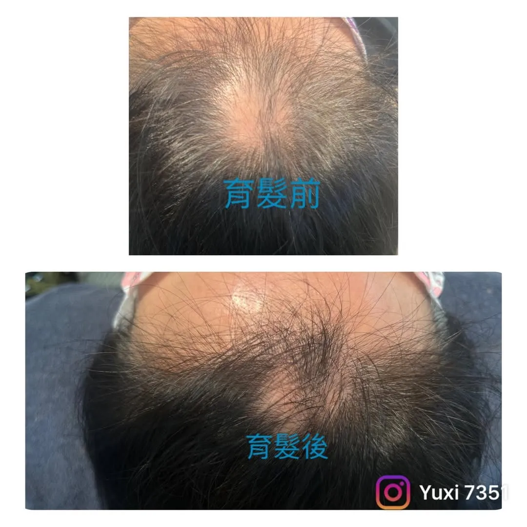 造成落髮問題6大類
