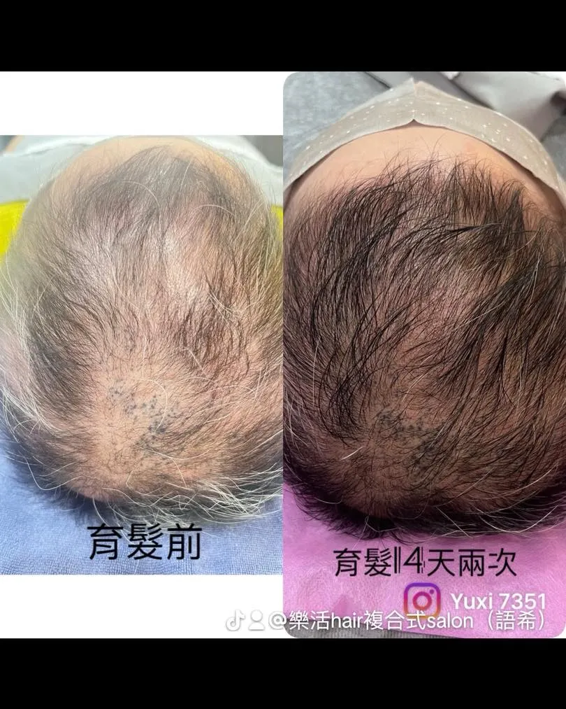 造成落髮問題6大類