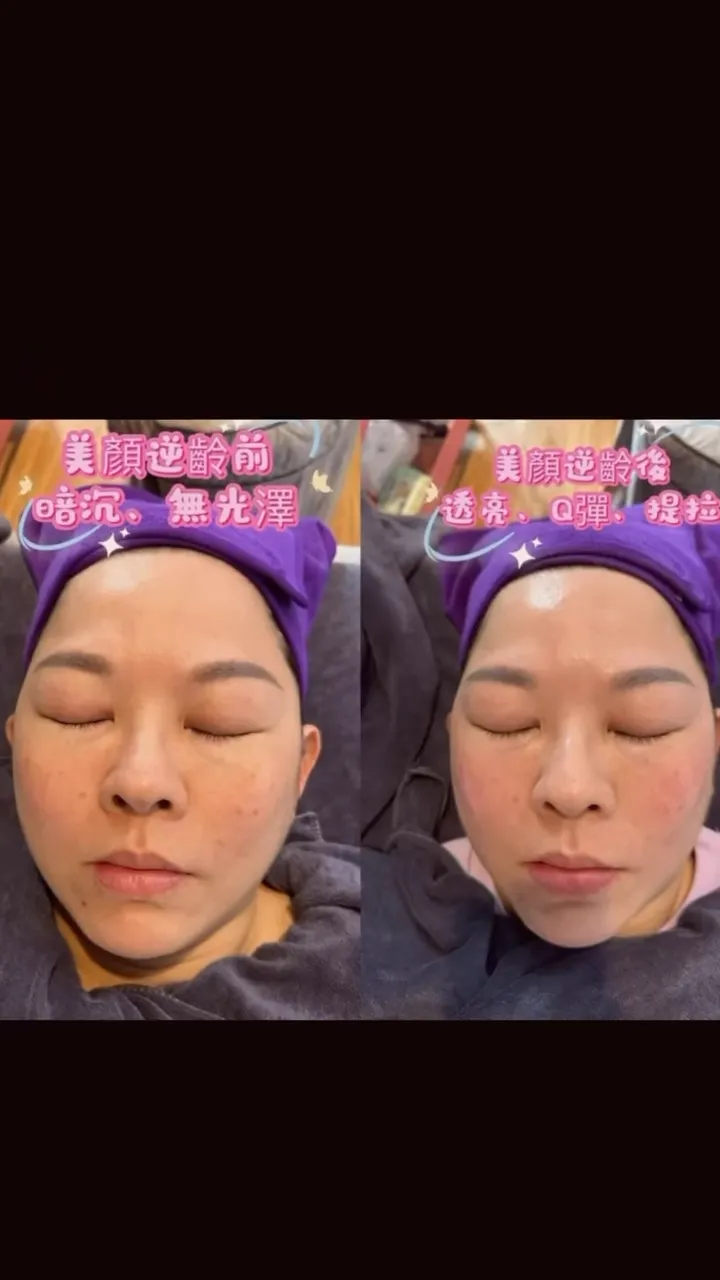 好的膚質有的人天生麗質｜台中臉部撥筋｜龍井臉部撥筋