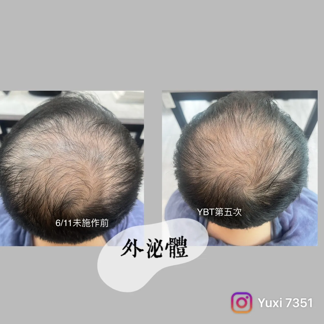 Y B T是 頭皮養護最高境界