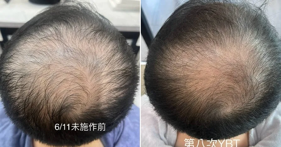 落髮危機 是現在很多人的困擾