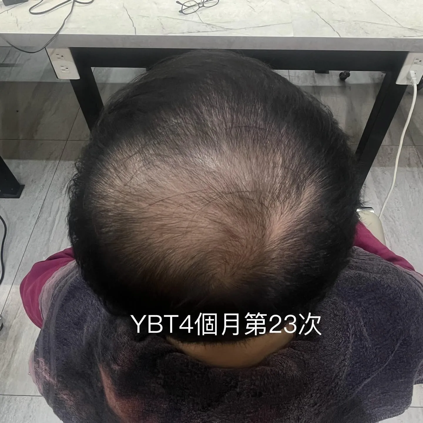 落髮不分男女 調理才是根本