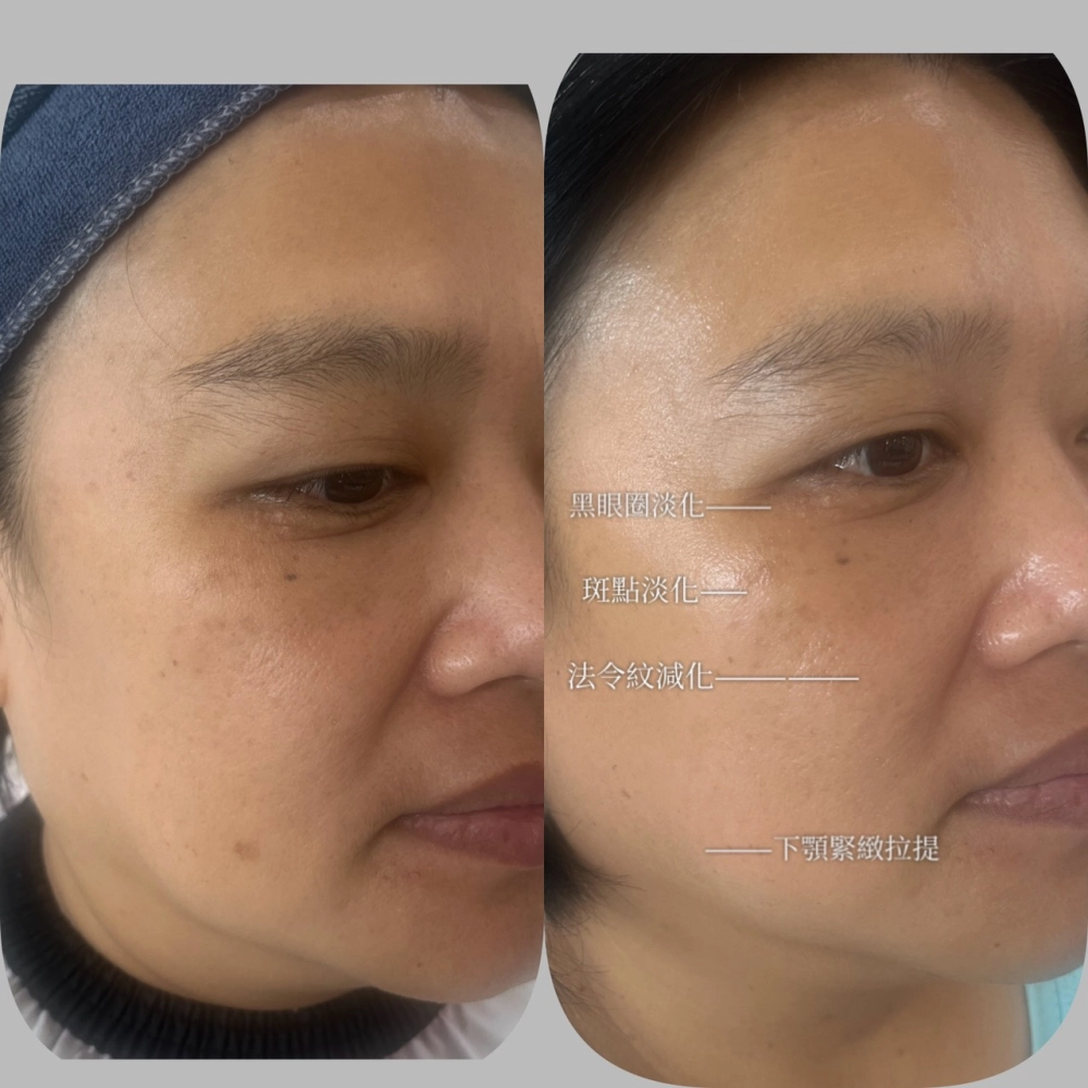 臉部SPA｜台中臉部保養
