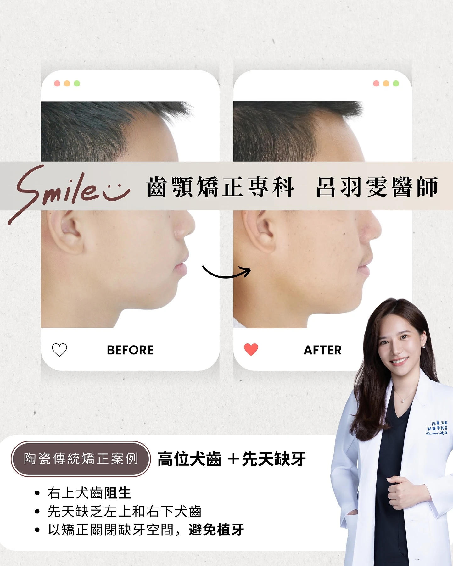 《 案例分享｜阻生齒＋先天缺牙 》