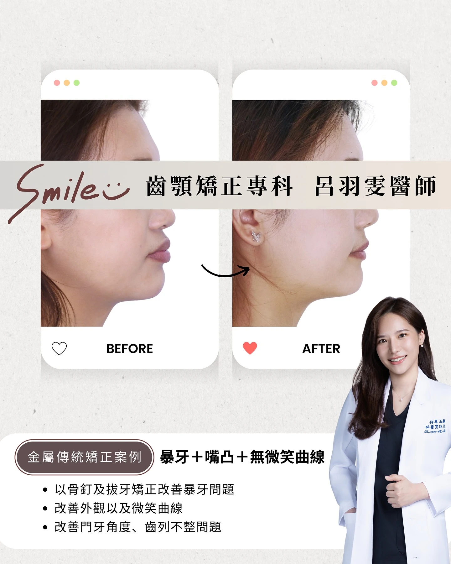 《 案例分享 I 暴牙＋嘴凸 》