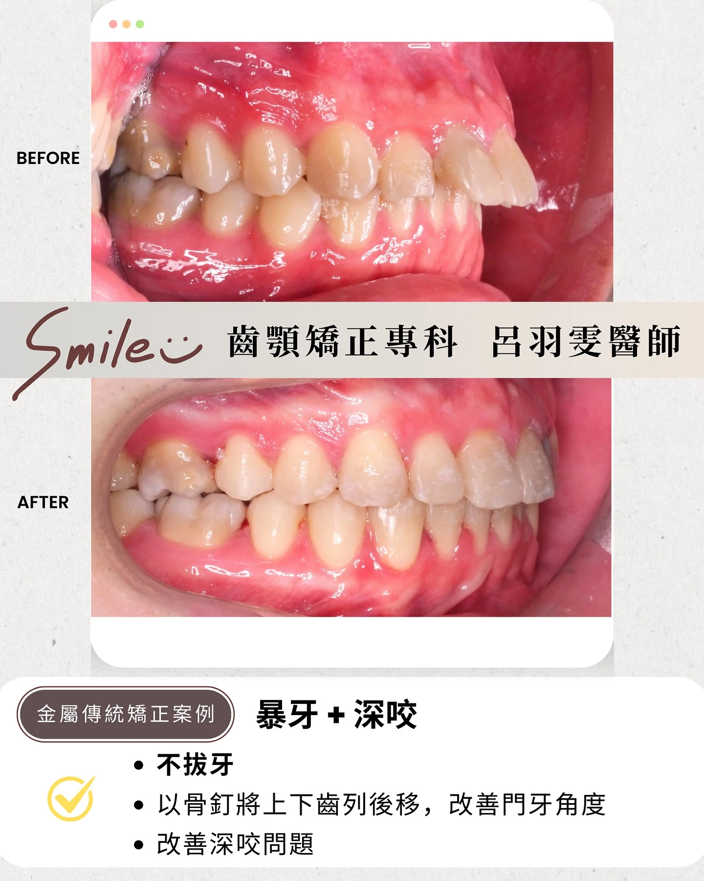《案例分享 ｜ ✨非拔牙矯正改善暴牙》