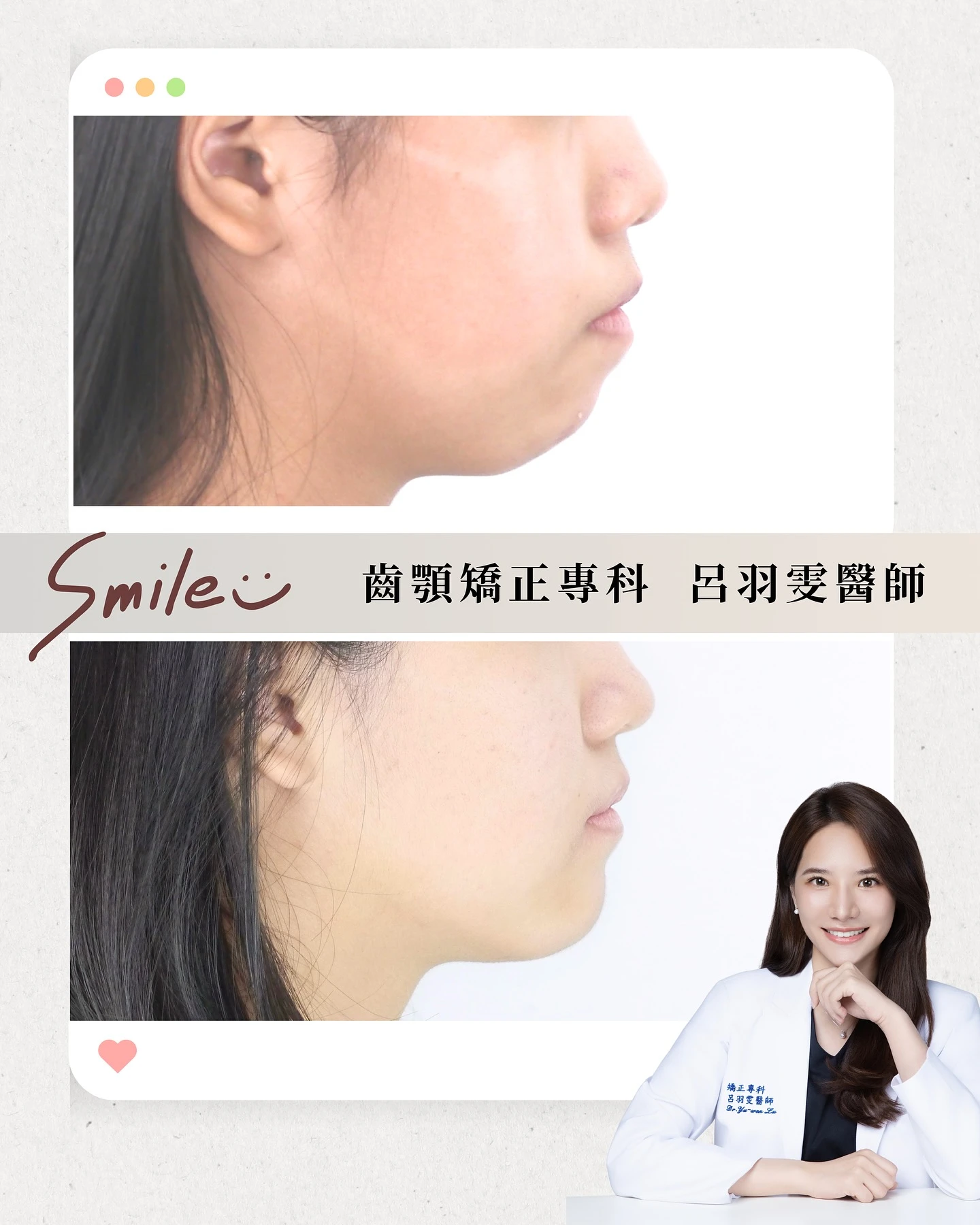 《案例分享｜下顎後縮》