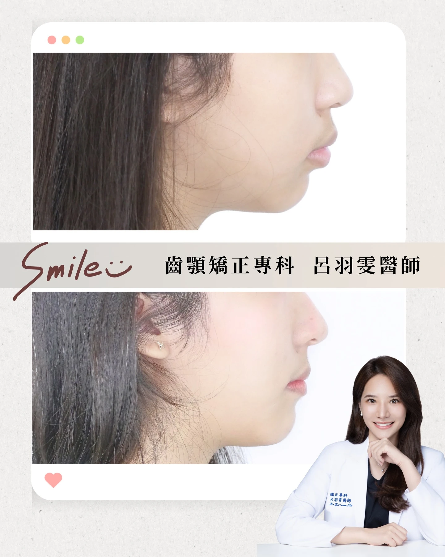 《案例分享｜天生缺牙 × 嘴凸改善》