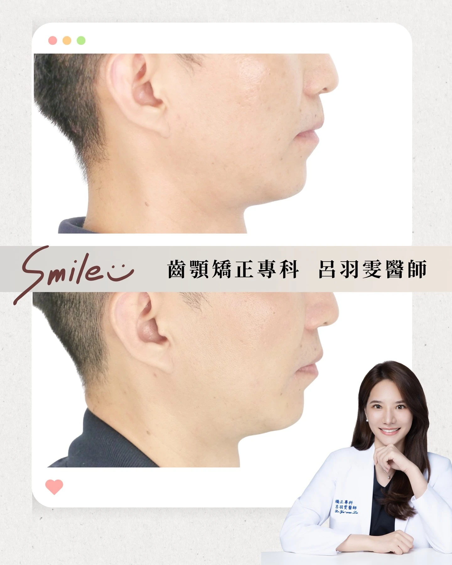《案例分享｜下顎前牙擁擠》