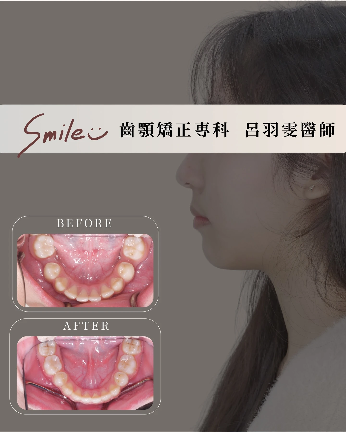 《案例分享｜天生缺牙 × 嘴凸改善》
