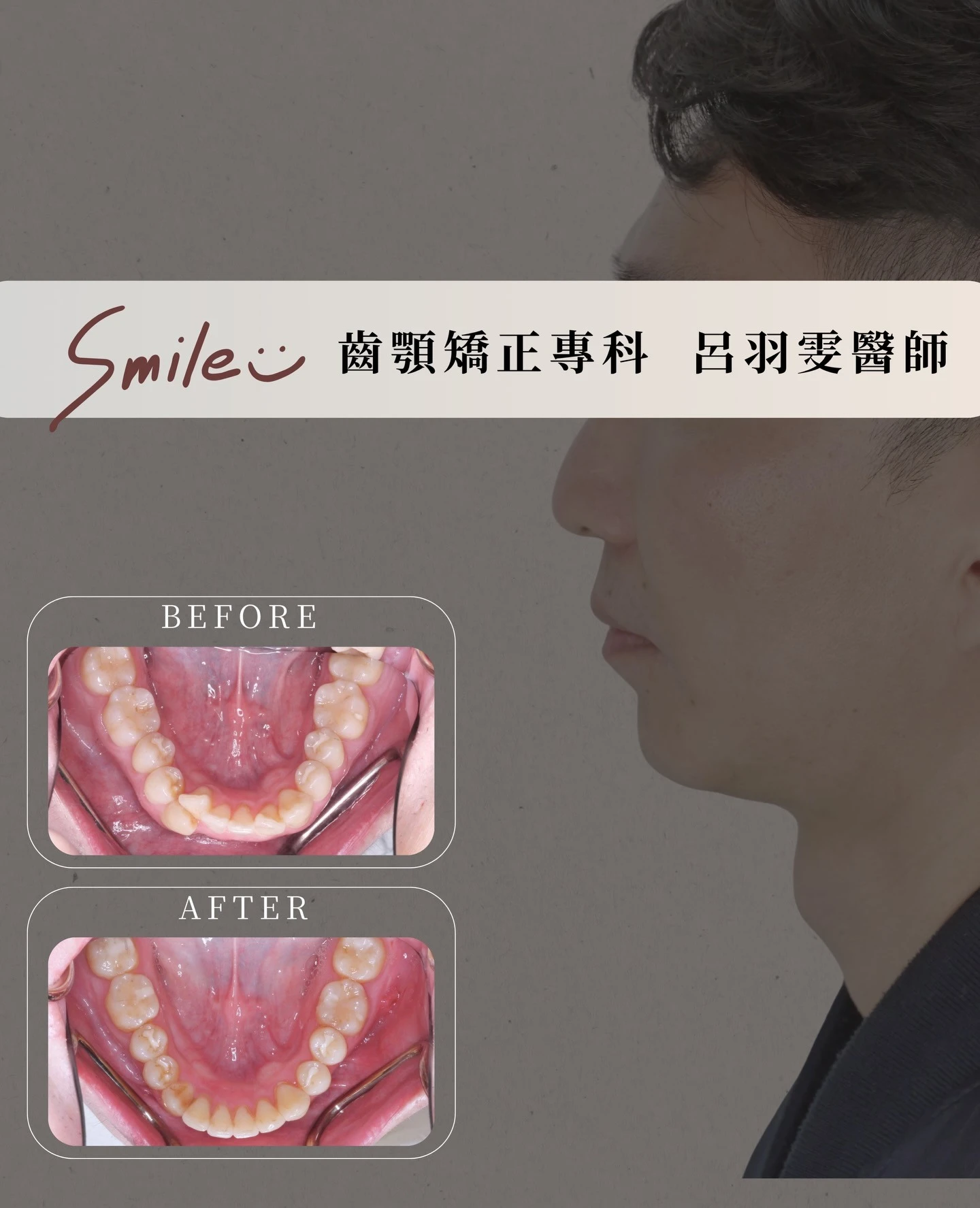 《案例分享｜下顎前牙擁擠》