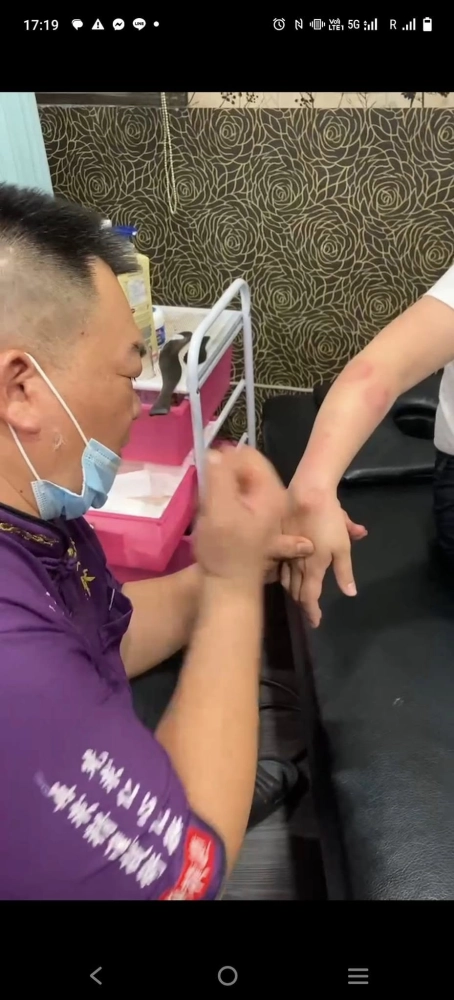 腱鞘囊腫