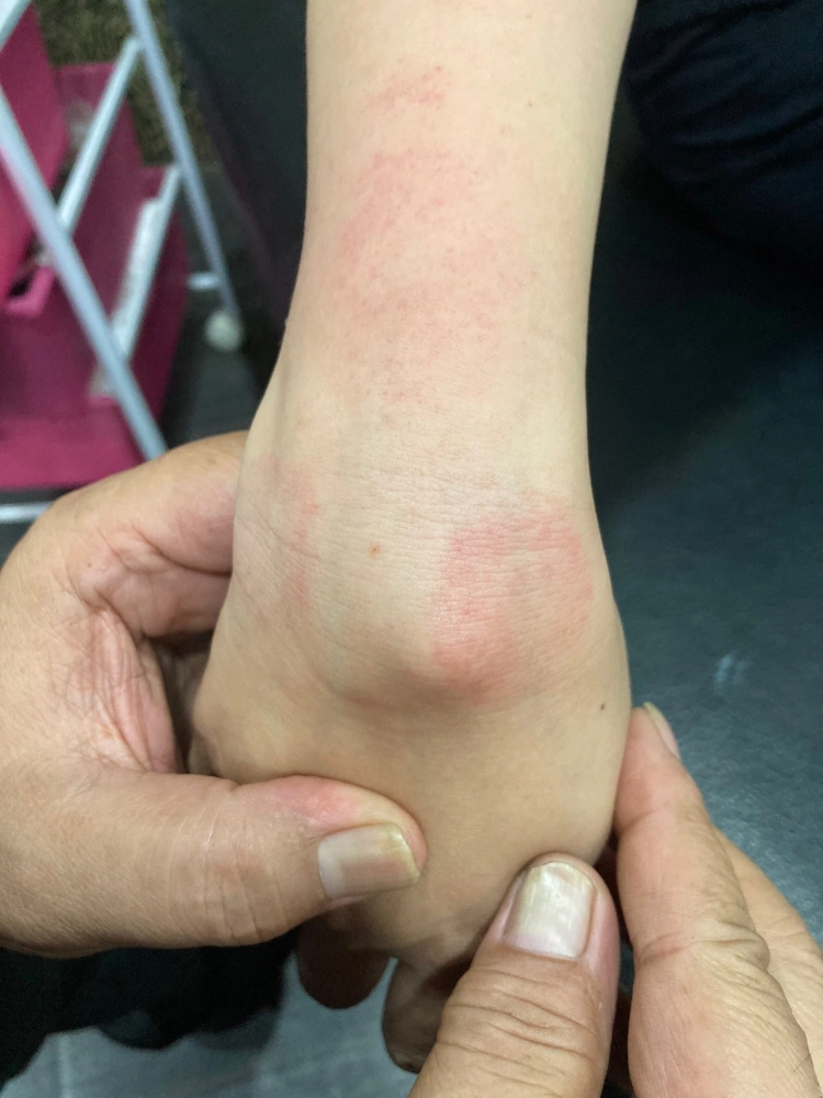 腱鞘囊腫