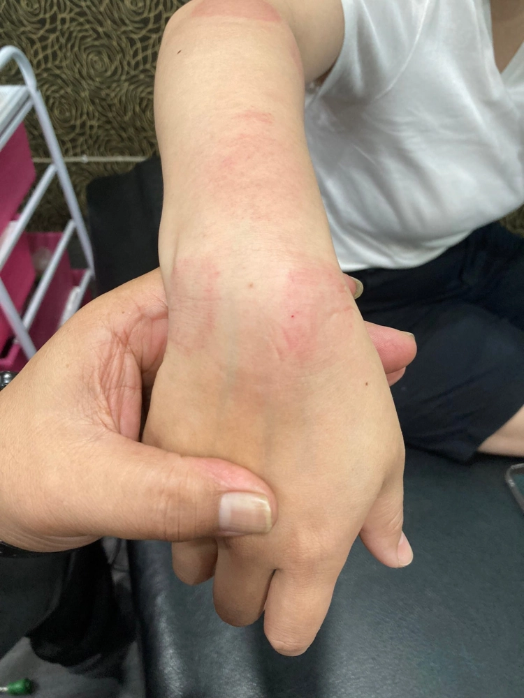 腱鞘囊腫