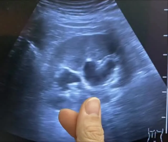 門診剛結束，手指愛心大家一定都看過了～