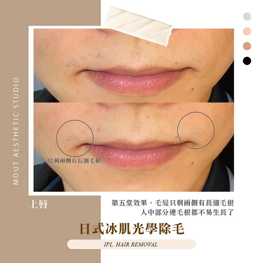 光學除毛效果太棒了