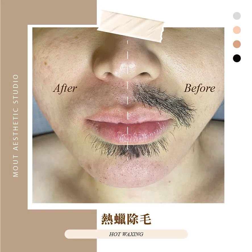熱蠟除毛是連根拔起的物理性除毛 會將毛根一併拔除