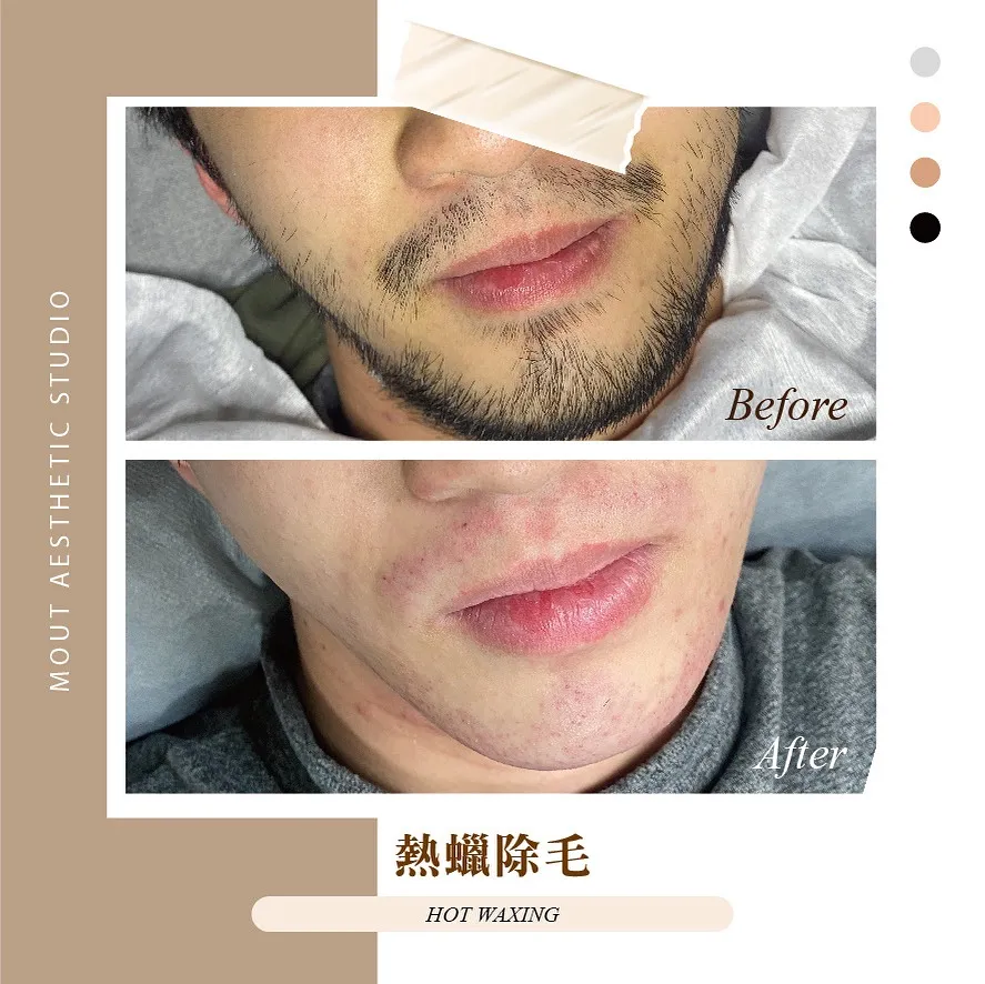 熱蠟除毛是連根拔起的物理性除毛 會將毛根一併拔除