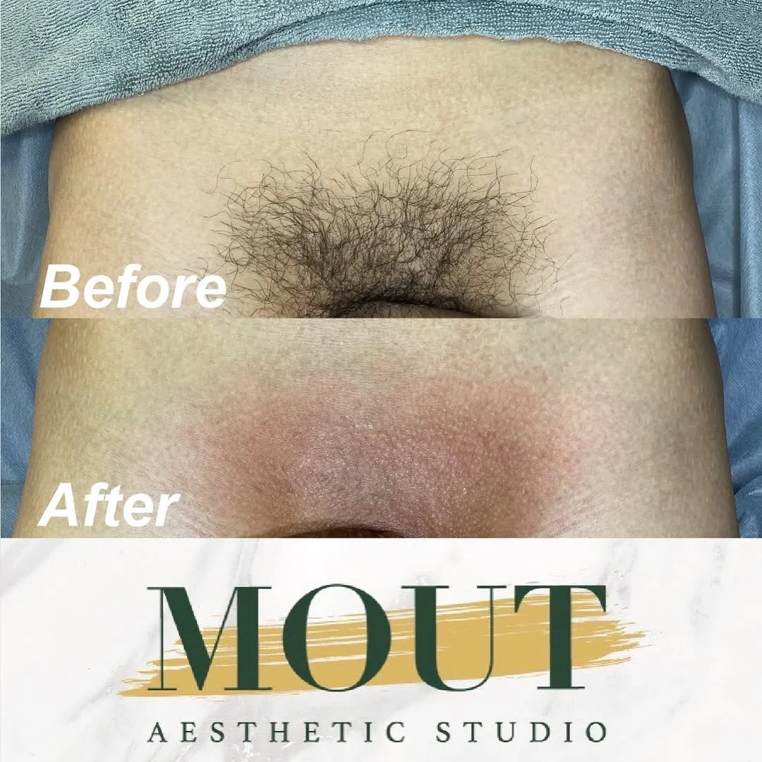 不論是夏天或冬天 男性的『小弟弟』因長年包裹在包皮裡頭