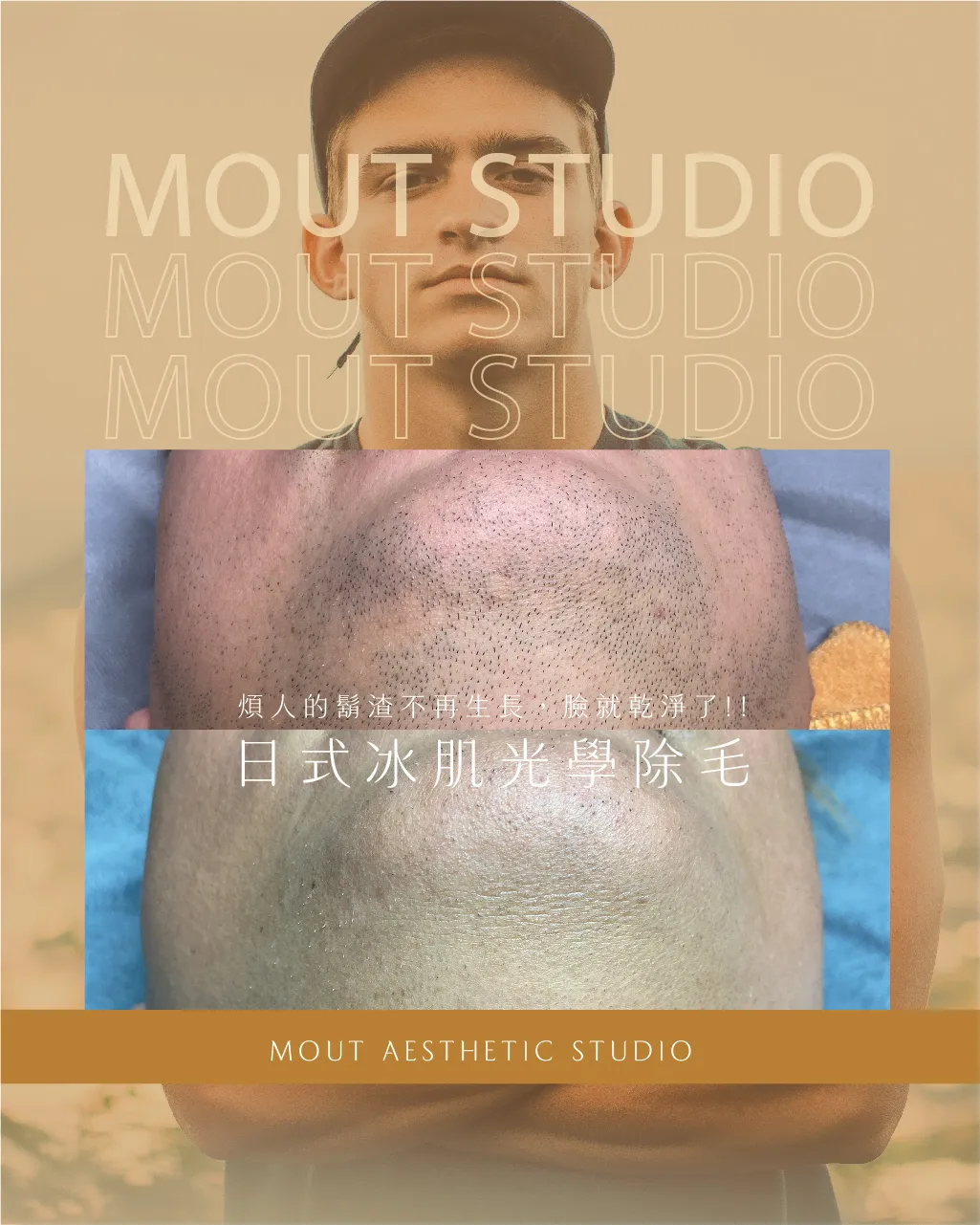 「日式冰肌光學除毛」— 全臉鬍子專屬方案