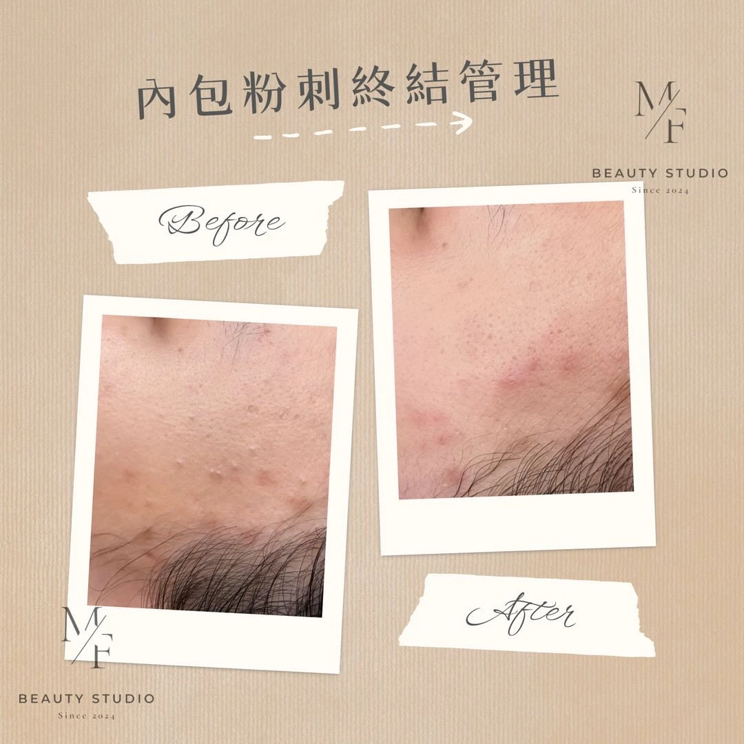 內包粉刺終結管理｜對比看得見