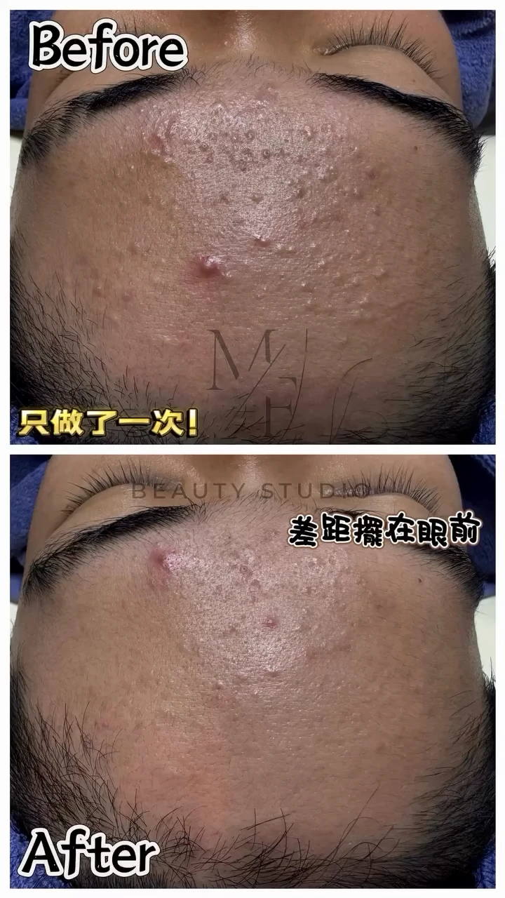 為什麼內包痘痘一定要清出來