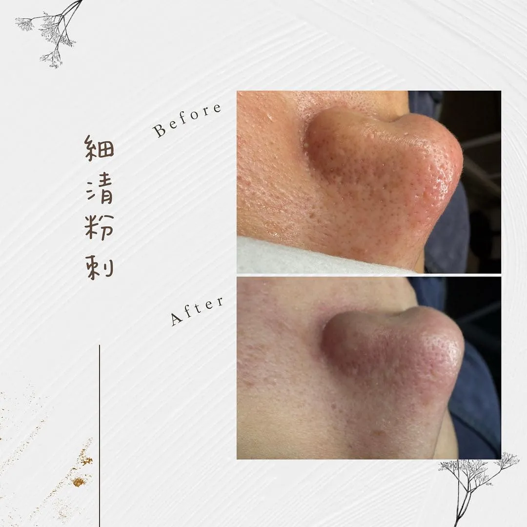 毛孔大作戰！讓肌膚重拾乾淨透亮的關鍵秘密