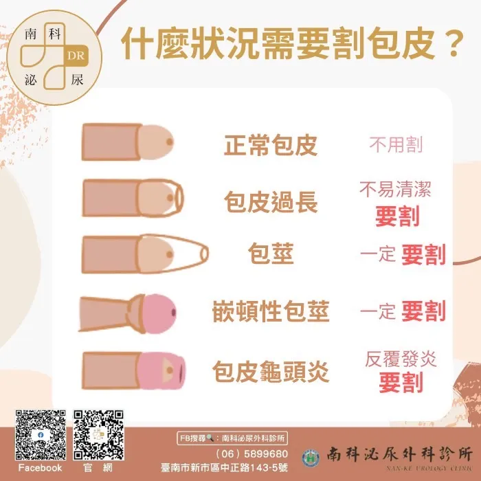 包皮手術大解析 !