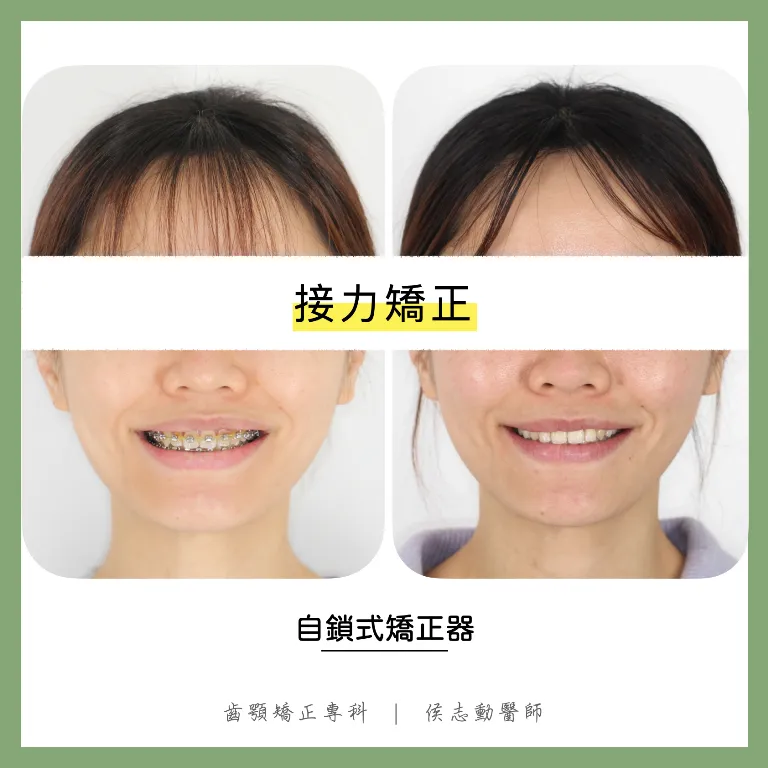 接力矯正/牙醫診所推薦,桃園牙齒矯正推薦
