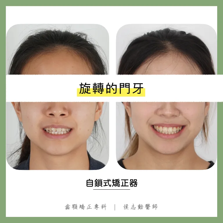 旋轉的門牙/齒顎矯正診所,桃園齒顎矯正