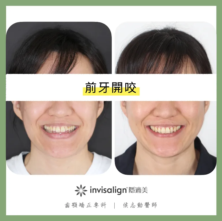 前牙開咬/桃園牙醫診所,桃園矯正牙齒