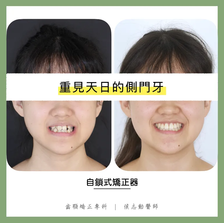 重見天日的側門牙/桃園矯正專科牙醫,桃園牙齒矯正醫師