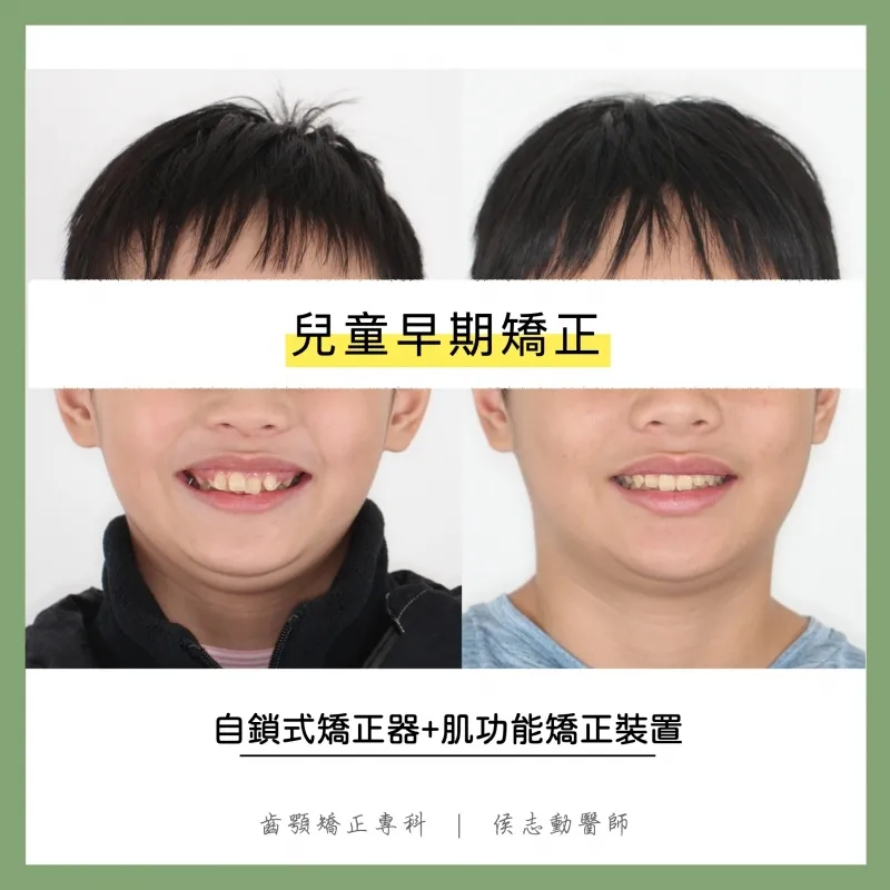 兒童早期矯正牙齒