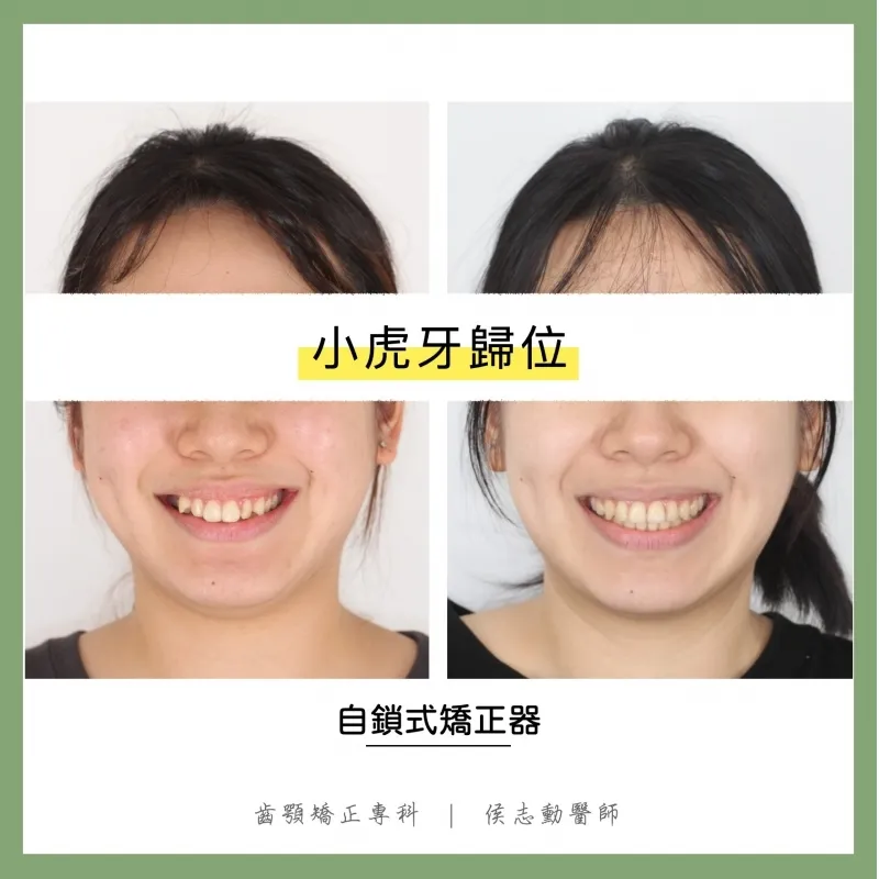 小虎牙歸位