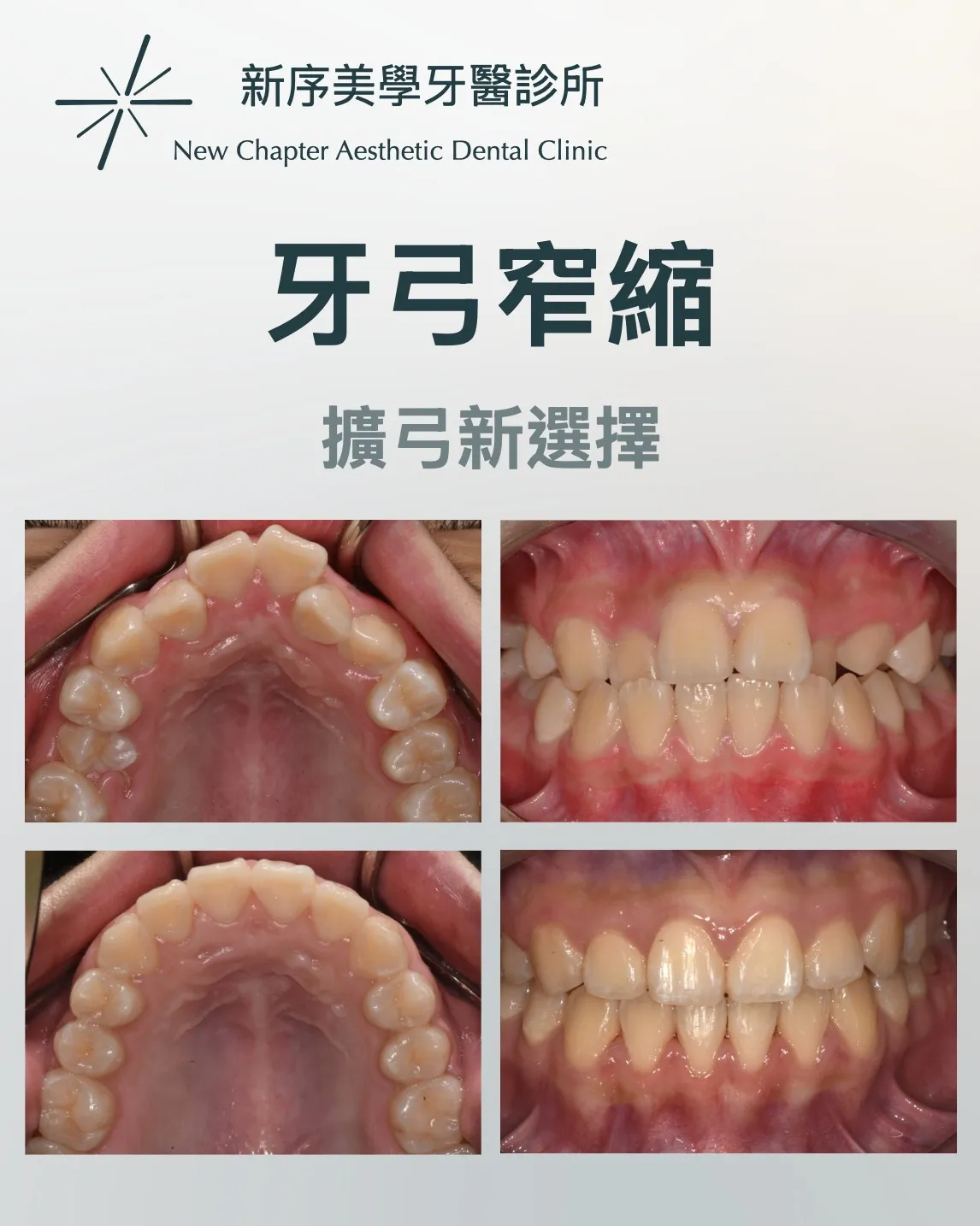 牙弓窄縮空間不足 造成擁擠、暴牙、甚至恆牙長不出來