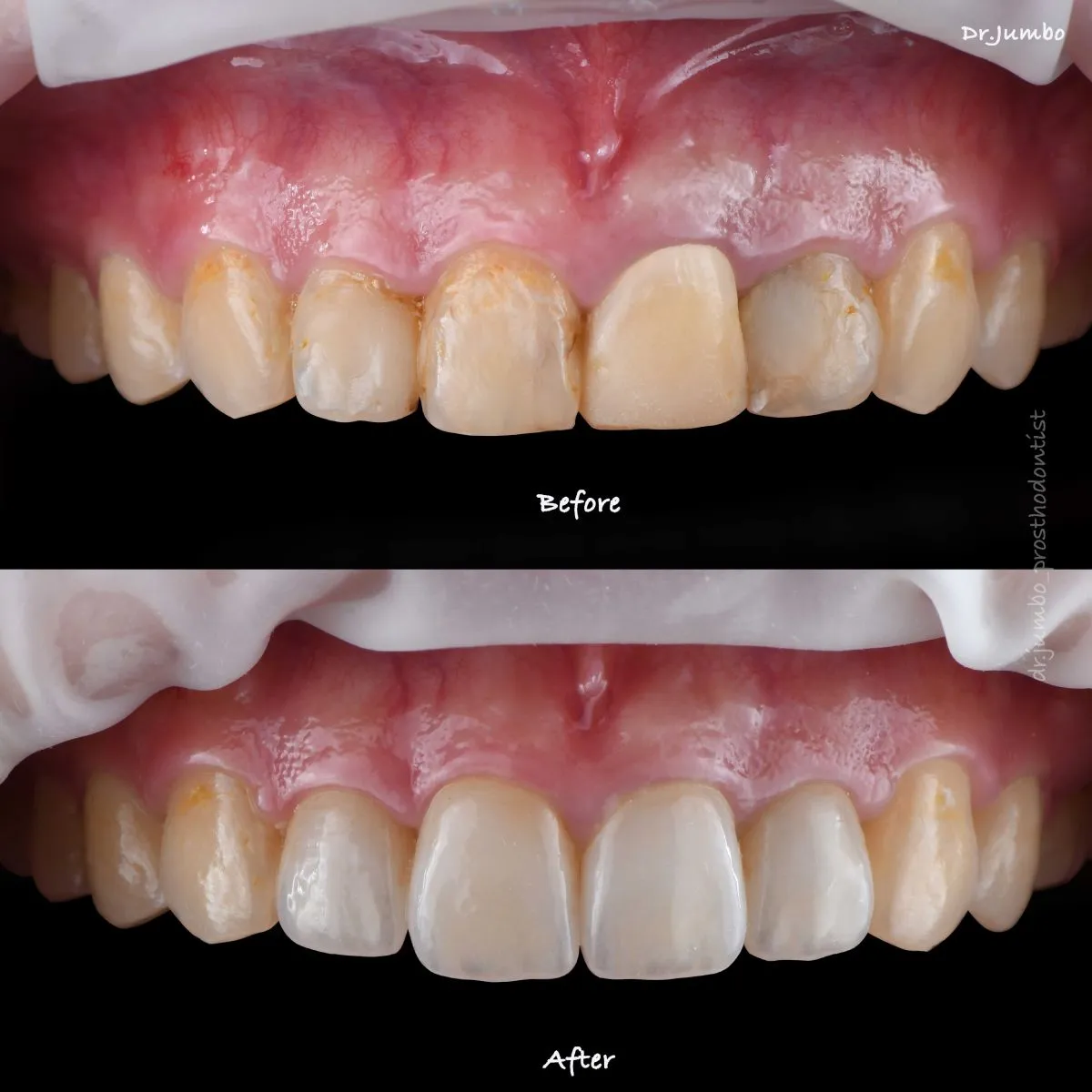全陶瓷固定假牙案例｜江柏昀醫師案例分享