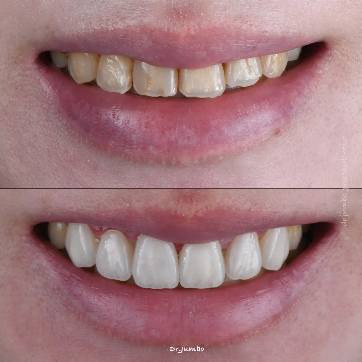 美白貼片案例｜江柏昀醫師案例分享