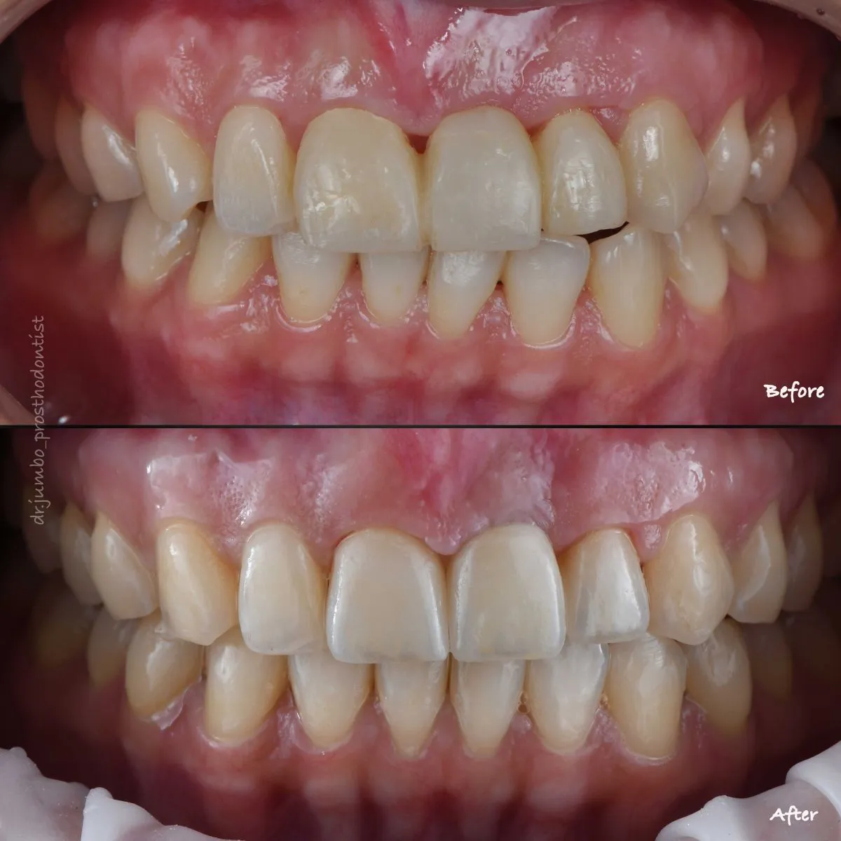 前牙矯正合併植牙案例｜江柏昀醫師案例分享