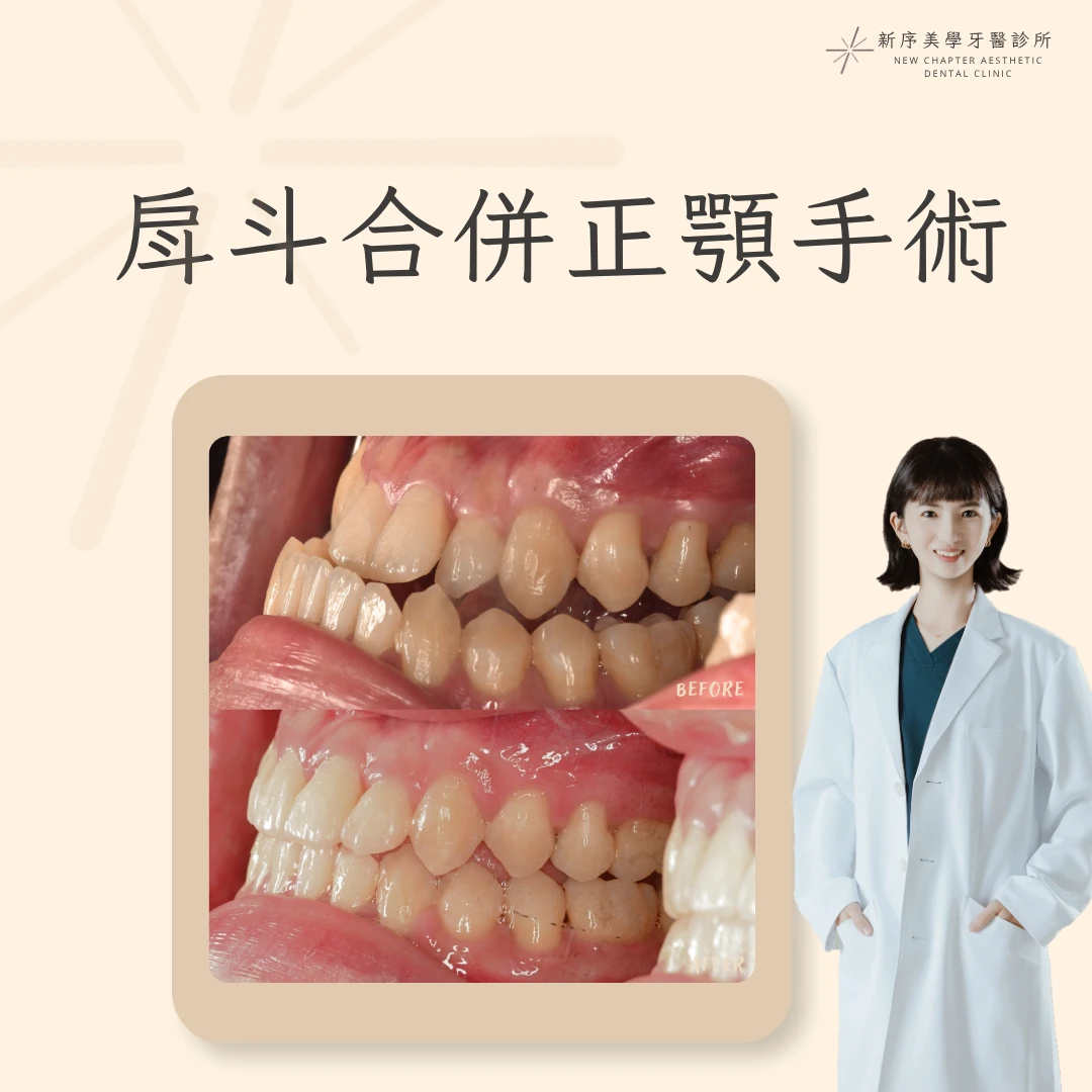 戽斗合併正顎手術案例 ｜郭亭余醫師案例分享
