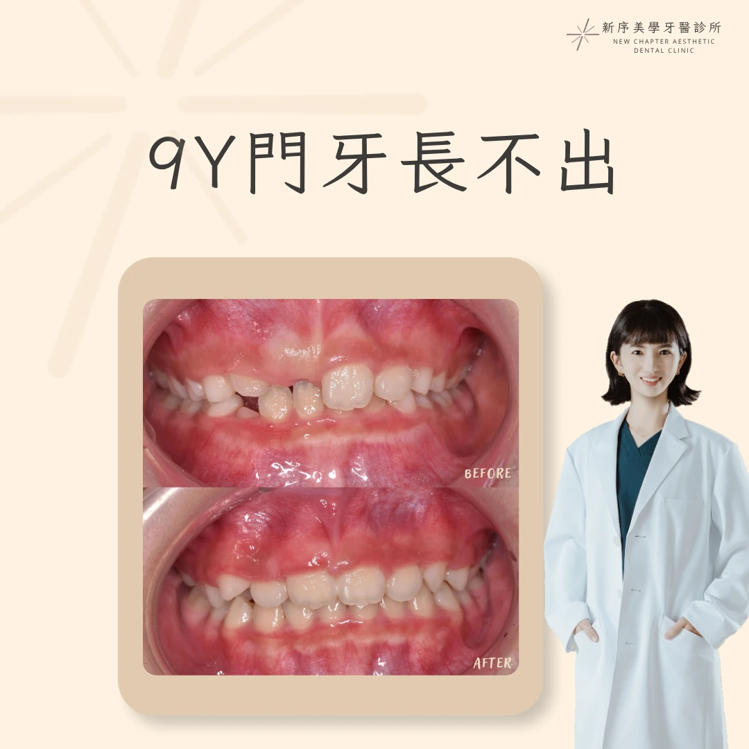 9Y門牙長不出案例 ｜郭亭余醫師案例分享