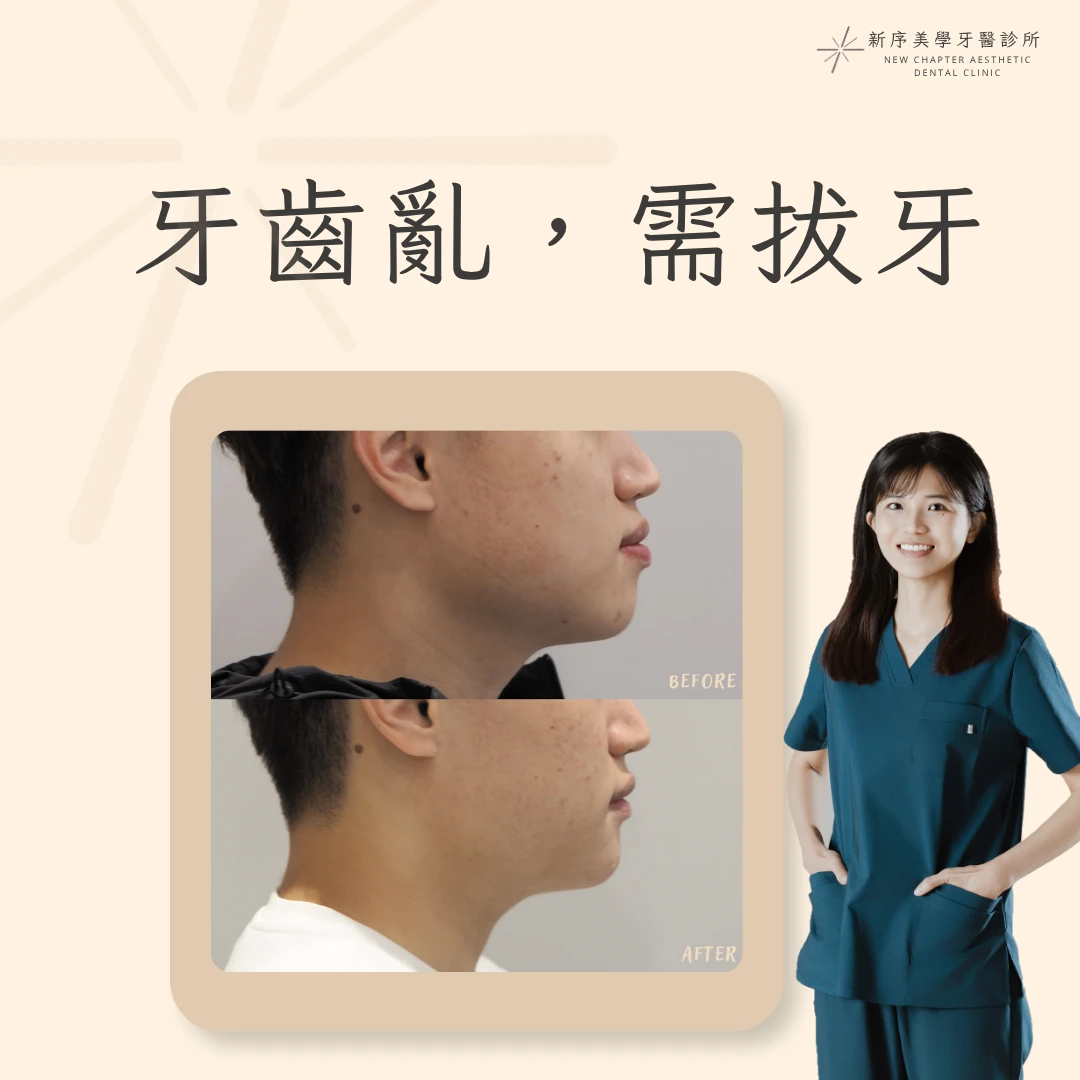 牙齒亂，需拔牙案例 ｜黃愉惠醫師案例分享