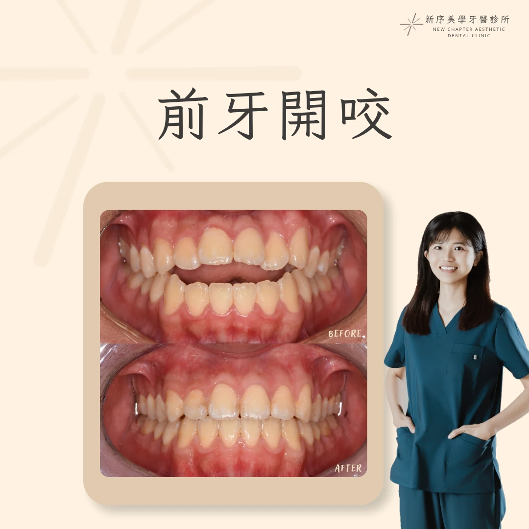前牙開咬案例 ｜黃愉惠醫師案例分享