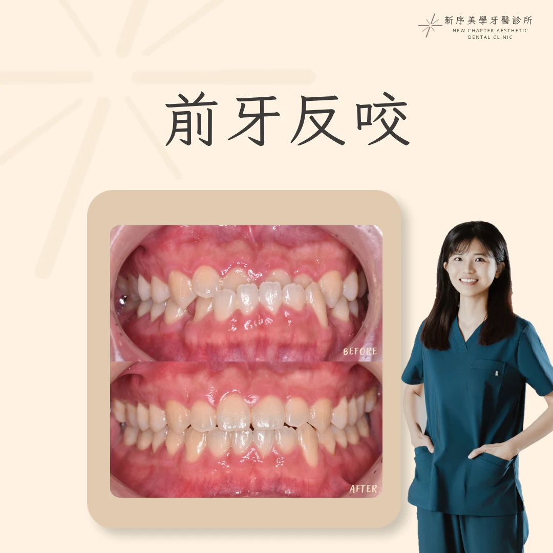 前牙反咬案例 ｜黃愉惠醫師案例分享