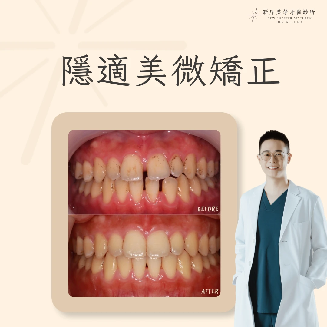 隱適美微矯正案例｜黃冠華醫師案例分享