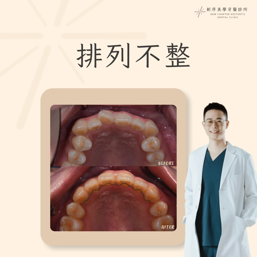 排列不整案例 ｜黃冠華醫師案例分享