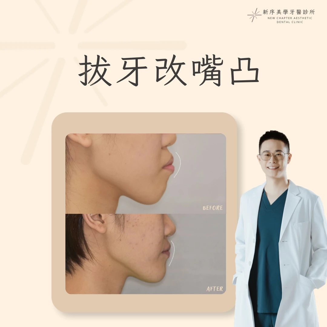 拔牙改嘴凸案例 ｜黃冠華醫師案例分享